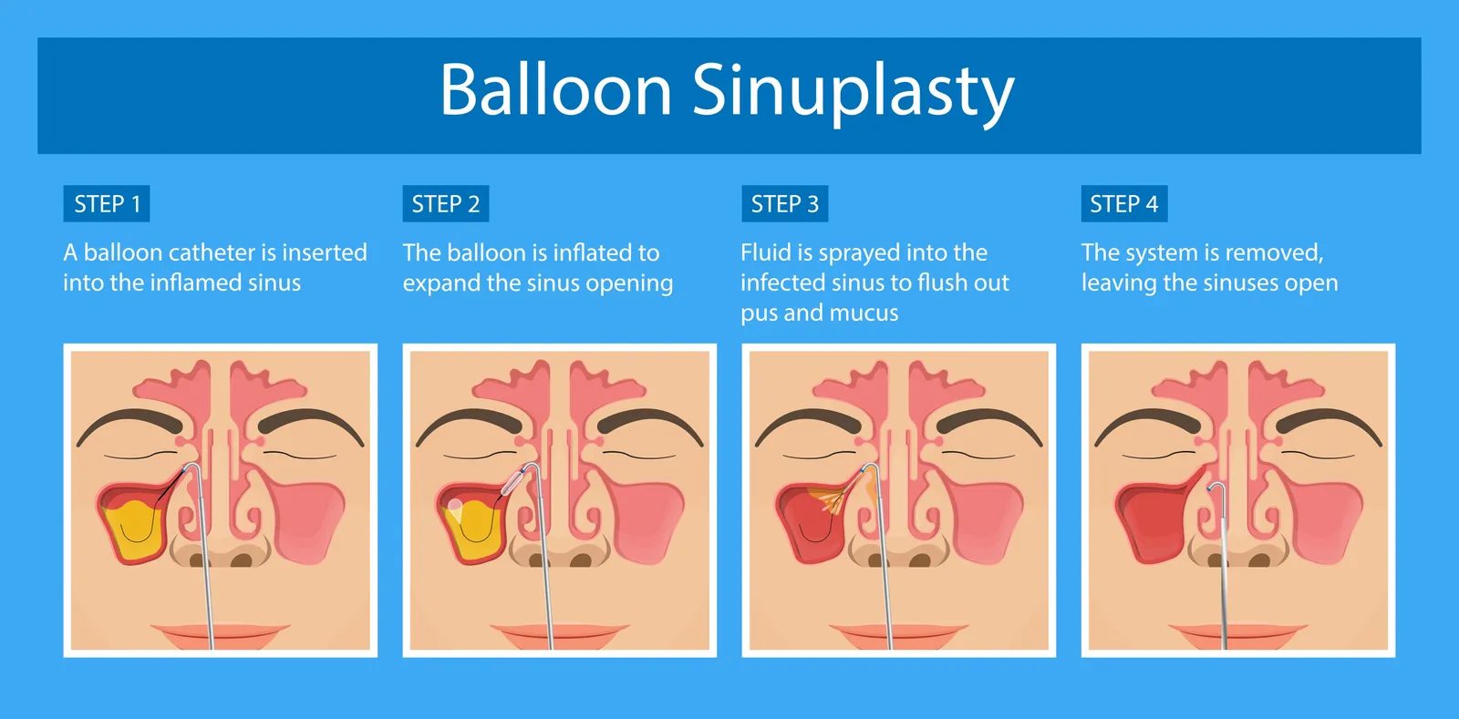 balloon sinuplasty